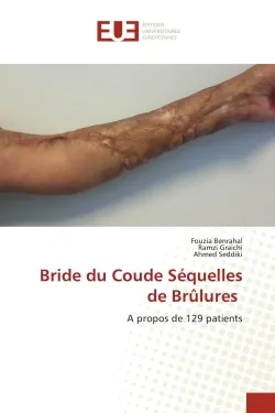 Bride du Coude Séquelles de Brûlures, A propos de 129 patients